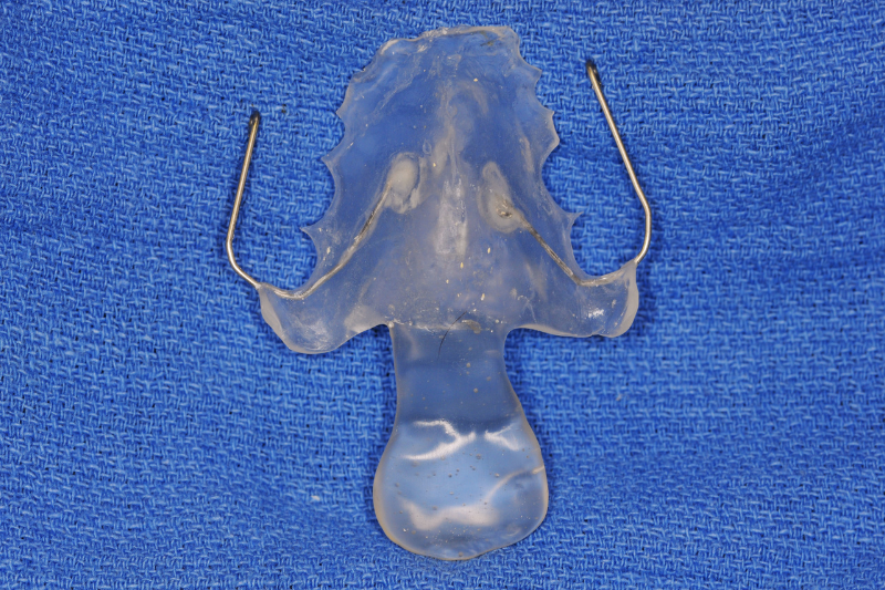 軟口蓋挙上装置